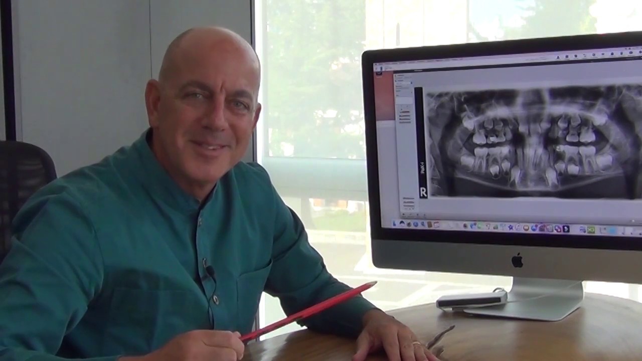 denti permanenti bambini che non crescono