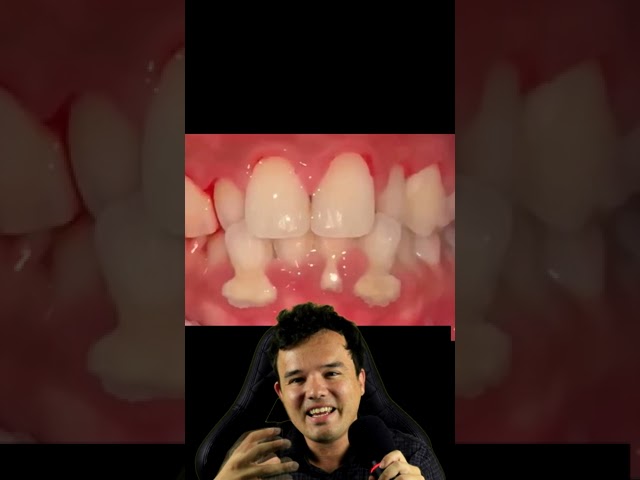 tartaro nero tra dente e gengiva