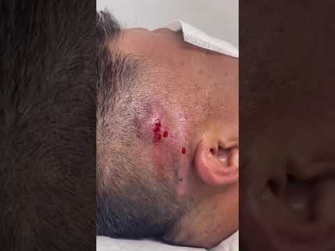 la clinica del pus quanto costa