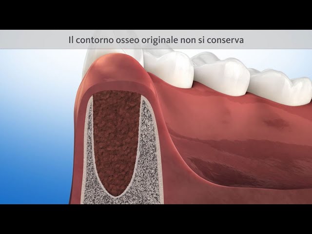togliersi un dente permanente da soli